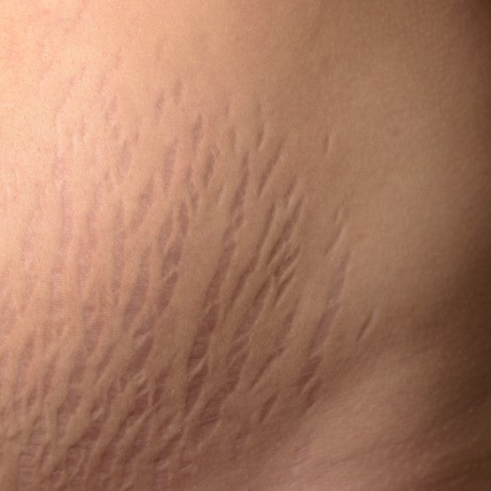 Stretch Mark – Lumish