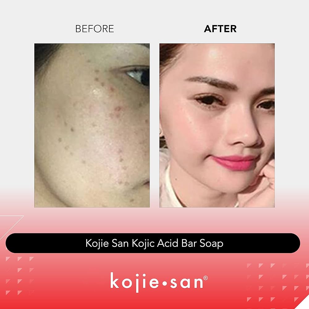 Kojie San Skin Lightening Soap