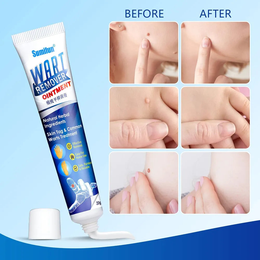 Wart Removal Ointment