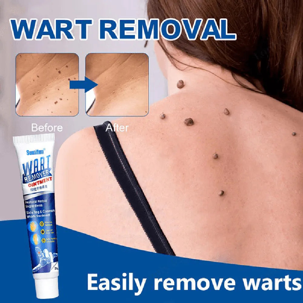 Wart Removal Ointment