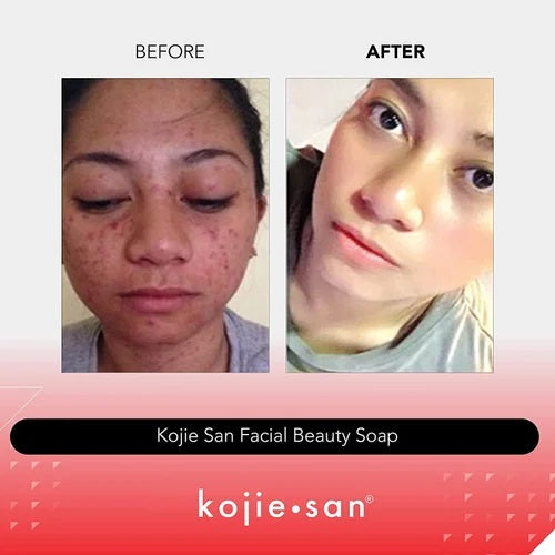 Kojie San Skin Lightening Soap